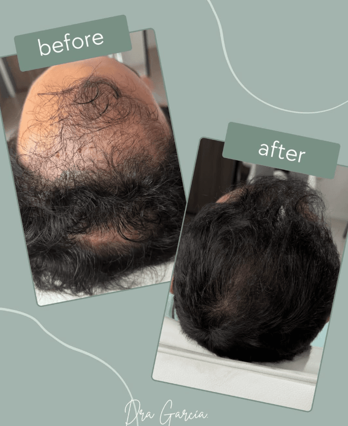 Antes y después de Mesoterapia Capilar